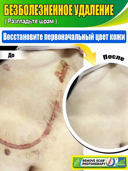 Лазерная указка для удаления шрамов, быстро удаляет гиперплазию, рубцы, атрофию, депрессию, пигментные рубцы, переносится в домашних условиях, без побочных эффектов.1 лазерная указка