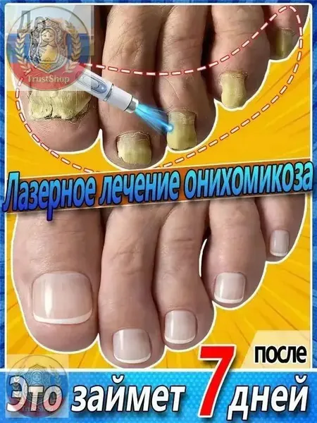 Лазерная ручка для лечения онихомикоза. Она позволяет быстро вылечить стойкий онихомикоз в течение 7 дней, устранить грибковые инфекции ногтей и гиперкератоз, а также стимулировать рост ногтей. 1 шт.