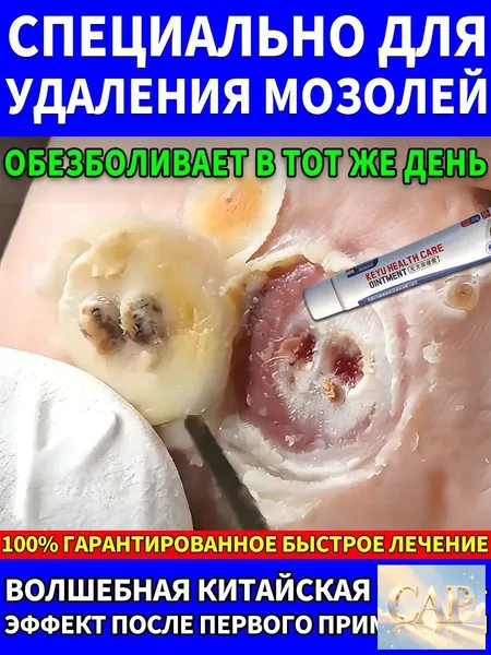 китайский Мазь от мозолей стержневых, колломак от бородавок, салипод от стержневых мозолей, Быстродействующий, Не содержит гормонов, Подходит для лица, шеи, рук, ног, ступней и всего тела.