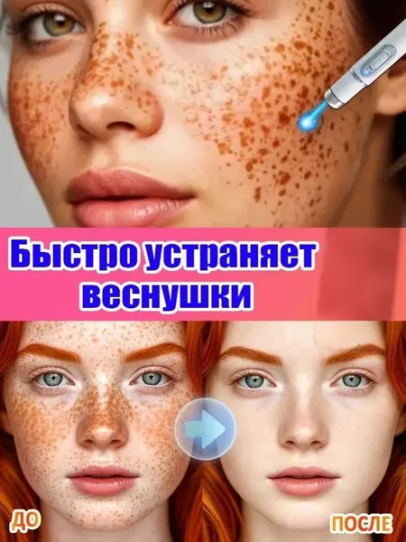 Удаляет пигментные пятна, веснушки, солнечные ожоги, меланодермию, угревую сыпь, морщины.Лазерная указка устраняет пигментацию на лице и теле и отбеливает кожу.1 палочка