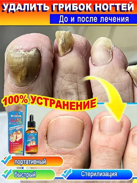 Эфирные масла используются для лечения грибковых инфекций ногтей на ногах и ногах. Подходят для потрескавшихся, зудящих, обесцвеченных и утолщенных ногтей. Предотвращают рецидивы.