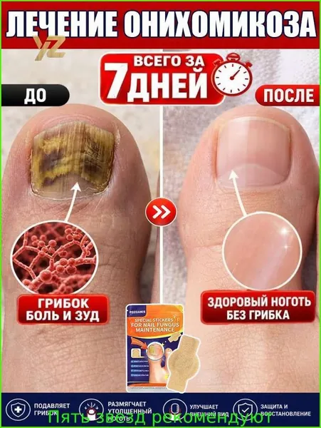 Эффективные пластыри для лечения онихомикоза: быстро лечат онихомикоз и паронихию, восстанавливают поврежденные ногти, устраняют пожелтение и ломкость, подходят для рук и ног. 21 шт.
