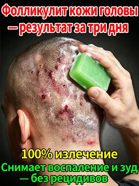 Лечебное мыло от фолликулита кожи головы противогрибковое натуральное снимает зуд и воспаление быстрый результат