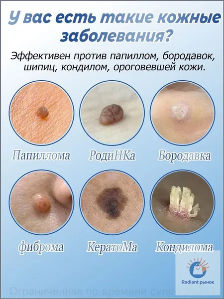 Безболезненное удаление бородавок, папиллом, родинок и подошвенных образований достигается за 7 дней, обеспечивая качественное восстановление кожи без остатка и побочных эффектов.