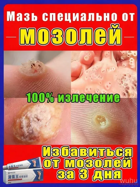 Эффективный крем для быстрого избавления бородавок, мозольный удаления мозолей, натоптышей,средство от шипиц на ногах,китайская чудо мазь 20 г от мазолей и надоптвшей,колломак от бородавок