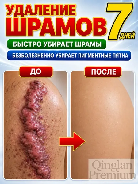 Этот крем от шрамов можно наносить на любую часть тела, он помогает избавиться от растяжек, ожогов и пигментных пятен. Его также можно использовать для лечения шрамов от постакне. 60 мл