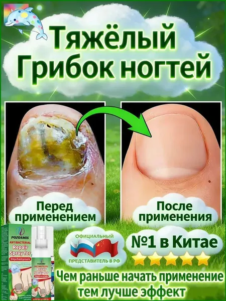 Качественный спрей против онихомикоза, масло для лечения грибка ногтей на стопах-+