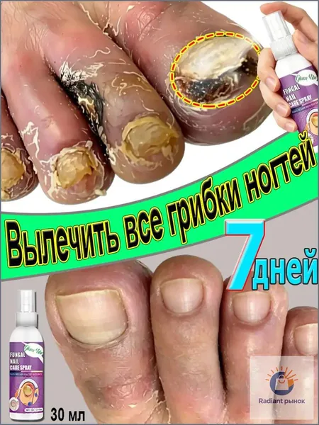 Спрей для лечения грибковых поражений ногтей на ногах, предотвращающий расслаивание, пожелтение и утолщение ногтей, восстанавливающий поврежденную кожу и околоплодник, а также устраняющий зуд.150 мл