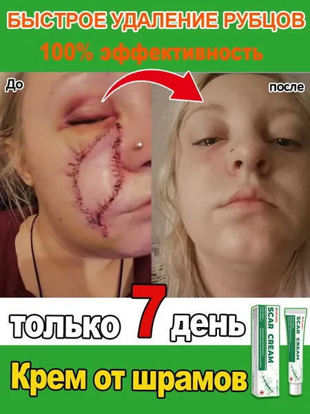 Крем для удаления шрамов. Быстро удаляет шрамы, растяжки, следы от акне и ожогов. Мягкий и не раздражающий, подходит как мужчинам, так и женщинам. 20 мл