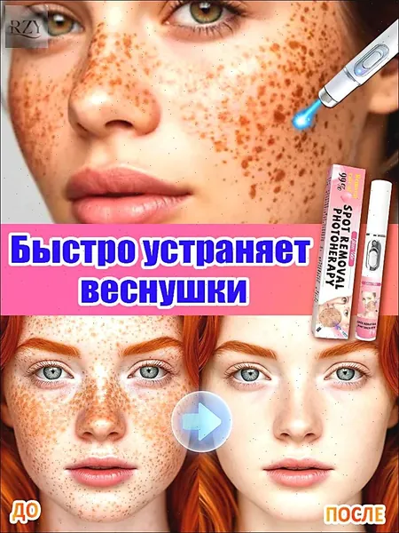 Лазерная ручка от веснушек эффективно удаляет веснушки, пигментные пятна и макулярные пятна, отбеливает кожу, восстанавливает ее и придает коже сияние.1 штука