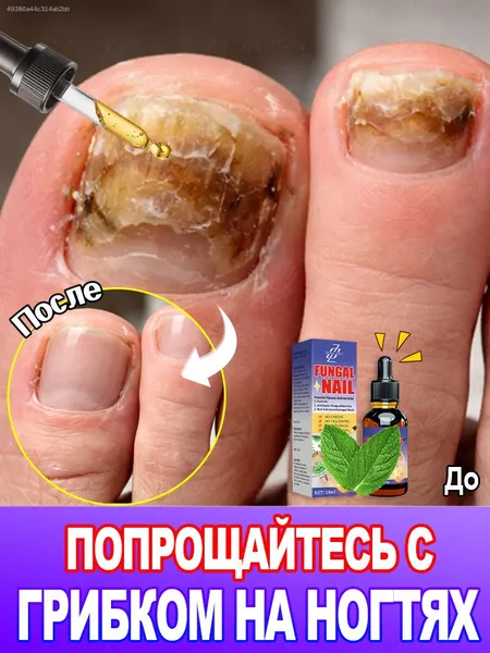 Эфирное масло от грибка ногтей глубоко подавляет грибковые заболевания, смягчает утолщенные, ломкие и потрескавшиеся ногти, а также успокаивает покраснение, отек и зуд ногтевой впадины.