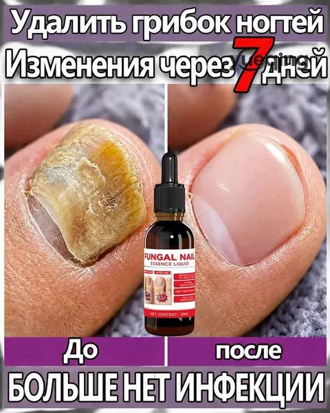Масло для лечения грибковой инфекции ногтей, помогает при плесневых инфекциях, укрепляет и восстанавливает ногти, способствует быстрому восстановлению, Против пота и запаха ног,10 мл.