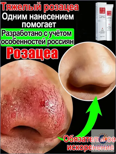 Крем от купероза для лица покраснений на лице и розацеа,Куперофаг Крем от купероза на лице, антикупероз, средство от сосудистых звездочек, от покраснений, розацеа,Китайская чудо-мазь.20 г