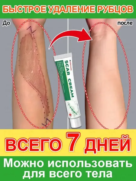 Крем от рубцов, применяется для быстрого заживления рубцов, растяжек, постакне, травм, пигментации, ожогов, восстановления гладкости кожи, безопасен и не имеет побочных эффектов. 30 мл.