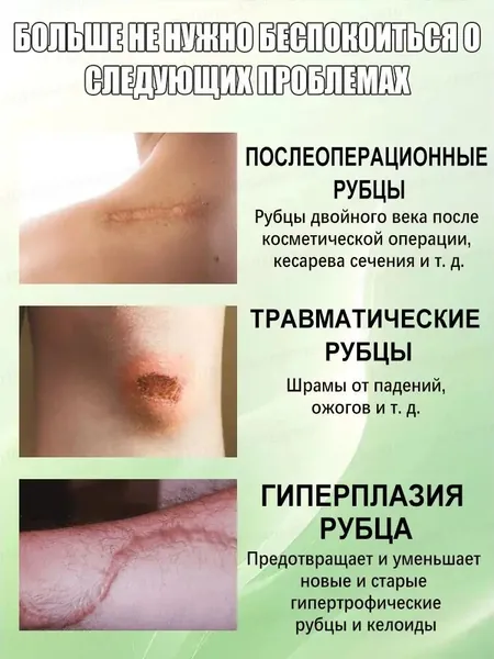 Крем от рубцов для лечения шрамов, травм и пигментации; выравнивает тон кожи, восстанавливает гладкость кожи и способствует быстрому заживлению рубцов. Подходит для любой части тела. 30 мл