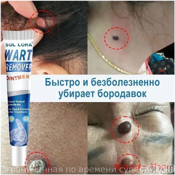 Эксклюзивное средство для удаления папиллом, бородавок и родинок на лице, руках и ногах представлено в форме мази с чистотелом объемом 20 г, предназначенной против кожных новообразований