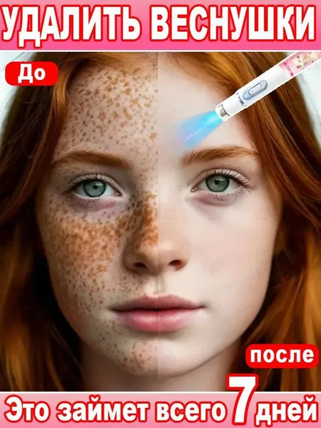 Лазерное удаление веснушек быстро и эффективно удаляет веснушки, пигментные пятна, мелазму и другие виды пигментации; осветляет и выравнивает тон кожи. 1 шт.