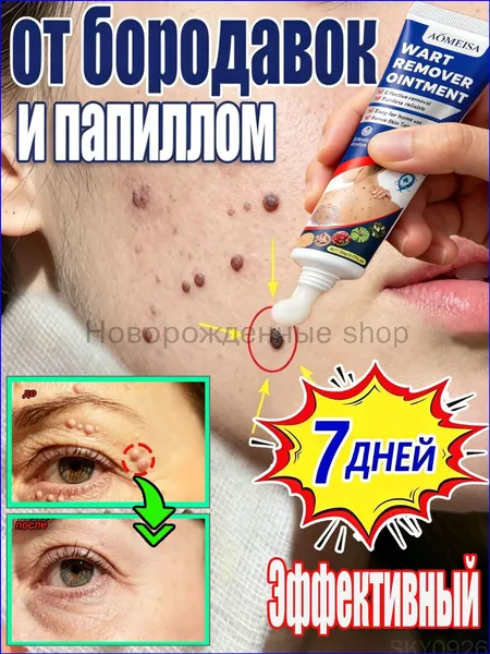 Крем для удаления бородавок. Его можно использовать для удаления натоптышей, бородавок, кожных высыпаний, папиллом и сухих мозолей.Безболезненно, без рубцов и побочных эффектов.