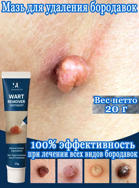 От бородавок за 7 дней : SUSUVETA удаление папиллом, родинок и подошвенных бородавок. Безболезненно, без остатков, без побочных эффектов безопасное и эффективное восстановление кожи.