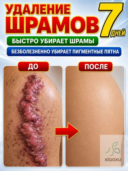 Этот крем от шрамов можно наносить на любую часть тела, он помогает избавиться от растяжек, ожогов и пигментных пятен. Его также можно использовать для лечения шрамов от постакне. 20 мл