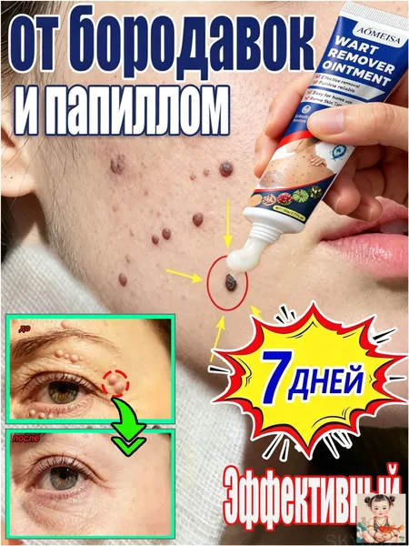 Крем для удаления бородавок. Его можно использовать для удаления натоптышей, бородавок, кожных высыпаний, папиллом и сухих мозолей.Безболезненно, без рубцов и побочных эффектов.