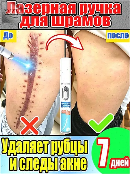 Лазерная ручка от шрамов эффективно удаляет гипертрофические рубцы, следы от угревой сыпи, растяжки и послеродовые раны, осветляет пигментацию и разглаживает кожу. 1 упаковка.