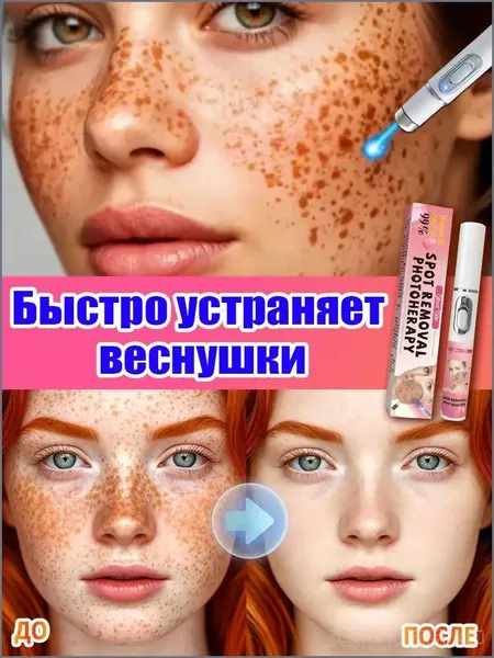 Лазерная ручка от веснушек эффективно удаляет веснушки, пигментные пятна и макулярные пятна, отбеливает кожу, восстанавливает ее и придает коже сияние.1 штука