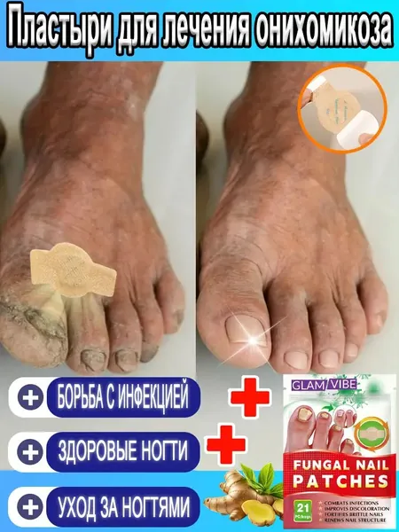Противогрибковые пластыри для ногтей и кутикулы,Используемый для лечения грибковых инфекций и онихолизиса, он обладает противогрибковыми свойствами и способствует росту и укреплению ногтей.
