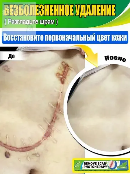 Лазерная указка для удаления шрамов, быстро удаляет гиперплазию, рубцы, атрофию, депрессию, пигментные рубцы, переносится в домашних условиях, без побочных эффектов.1 лазерная указка