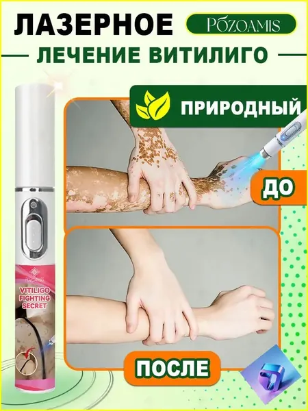 Премиальный лазерный стик для коррекции витилиго, которым белые пятна осветляются с высокой точностью, а тон кожи выравнивается. Безболезненно возвращается чистая, ровная и сияющая здоровьем кожа.