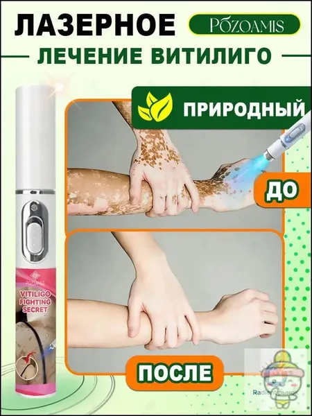 Лазерная ручка, разработанная специально для витилиго, точно осветляет белые пятна и выравнивает тон кожи. Без боли всего один стик поможет вернуть чистой, ровной и сияющей здоровой коже.