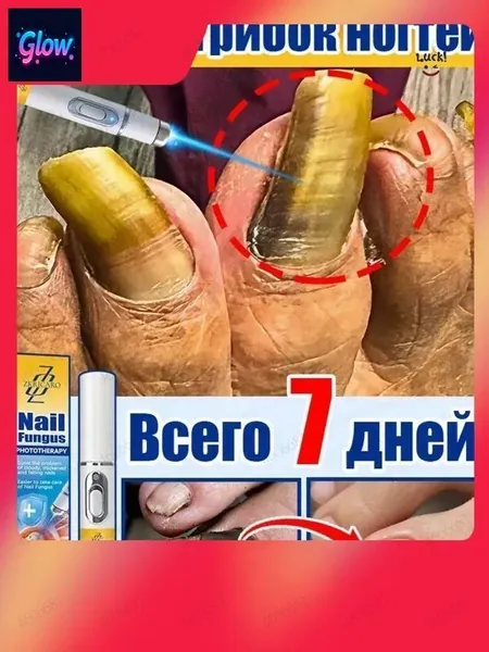 Эксклюзивный лазерный прибор для терапии онихомикоза гарантирует устранение устойчивой грибковой инфекции в течение недели, а также эффективно лечит паронихию, избавляя от утолщения