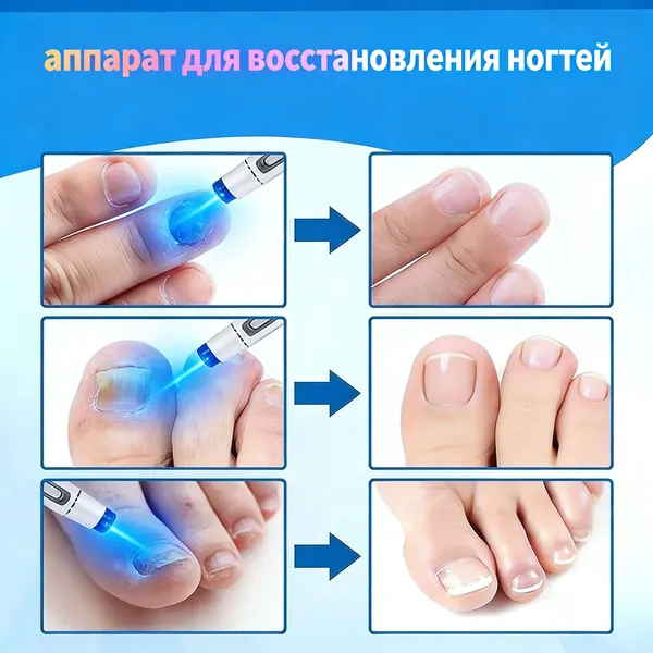 Лазерная указка, используемая для лечения грибка ногтей. Безболезненно удаляет стойкие ногти на ногах и грибок. Подходит для восстановления и ухода за ногтями.одна лазерная ручка