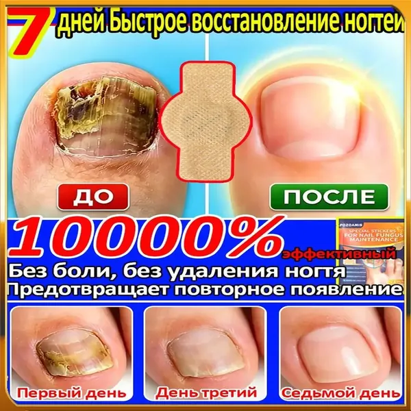Антигрибковые наклейки для лечения ногтевого грибка, избавление от онихомикоза и воспаления паронихита, быстрое восстановление ногтевой пластины, снятие дискомфорта, удобное использование,105 шт