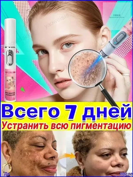 Удаляет пигментные пятна, веснушки, солнечные ожоги, меланодермию, угревую сыпь, морщины.Лазерная указка устраняет пигментацию на лице и теле и отбеливает кожу.1 палочка