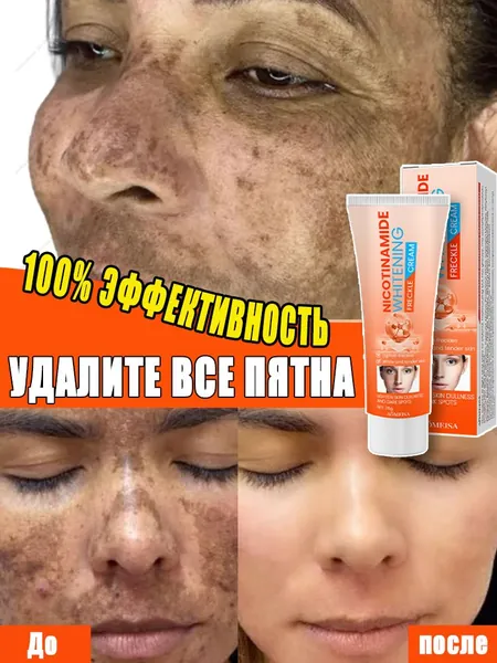 Крем для удаления веснушек и отбеливания способен удалить веснушки, хлоазму, солнечные пятна, пигментные пятна, улучшить тусклый тон кожи, бороться с пигментацией и выравнивать тон кожи.20ml