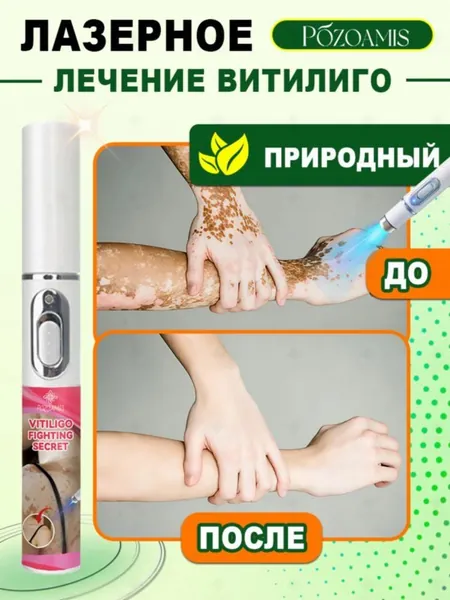Лазерная ручка, разработанная специально для витилиго, точно осветляет белые пятна и выравнивает тон кожи Без боли всего один стик поможет вернуть чистой, ровной и сияющей здоровой коже