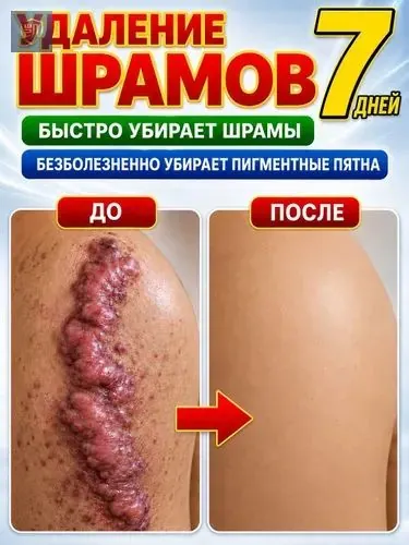 Этот крем от шрамов можно наносить на любую часть тела, он помогает избавиться от растяжек, ожогов и пигментных пятен. Его также можно использовать для лечения шрамов от постакне. 20 мл