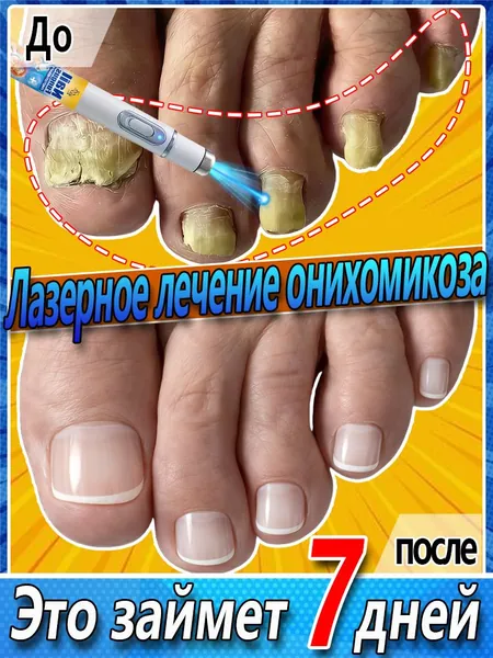 Лазерная ручка для лечения онихомикоза. Это средство быстро лечит грибковые инфекции рук и ног, улучшает состояние при паронихии, способствует росту ногтей и укрепляет их. 1 шт.