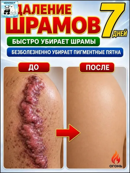 Этот крем от шрамов можно наносить на любую часть тела, он помогает избавиться от растяжек, ожогов и пигментных пятен. Его также можно использовать для лечения шрамов от постакне. 100 мл