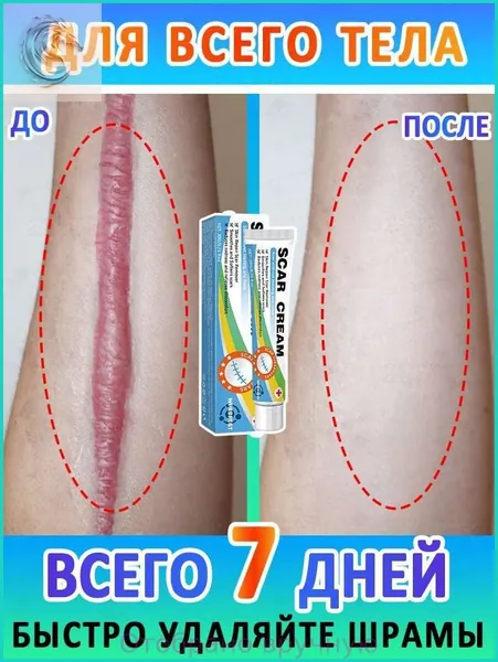 Этот крем для заживления рубцов снимает зуд и быстро удаляет гипертрофические рубцы, ожоги, угри, старые шрамы, растяжки, а также оказывает мягкое и нераздражающее действие.