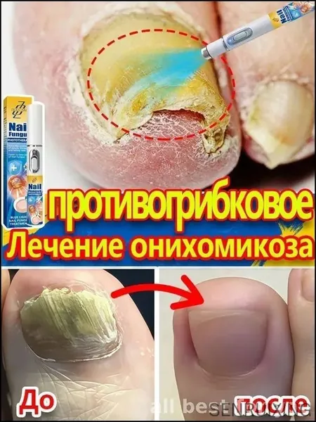 Инновационный лазерный аппарат для эффективного лечения грибка ногтей и онихолизиса на руках и ногах, премиум стимулятор роста и укрепления ногтевой пластины, комплексное решение для ухода
