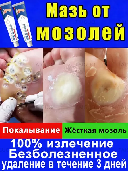 Эффективный крем для быстрого избавления бородавок, мозольный удаления мозолей, натоптышей,средство от шипиц на ногах,китайская чудо мазь 20 г от мазолей и надоптвшей,колломак от бородавок.