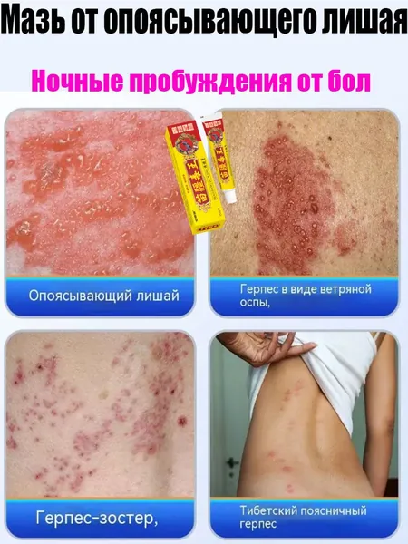 Мазь от опоясывающего герпеса, которая быстро снимает зуд и боль, используется для лечения постгерпетической опоясывающей невралгии и "змеиного стригущего лишая" для наружного применения