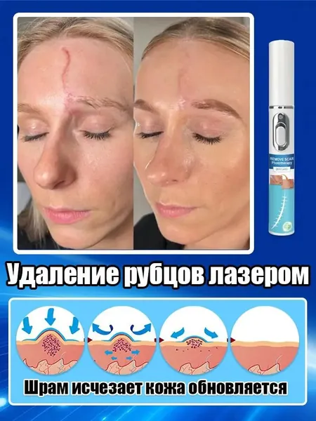 Лазерная ручка для удаления шрамов, используемая для удаления шрамов, растяжек, травм и пигментации, устранения рубцов, восстановления гладкости кожи и быстрого заживления. одна лазерная ручка