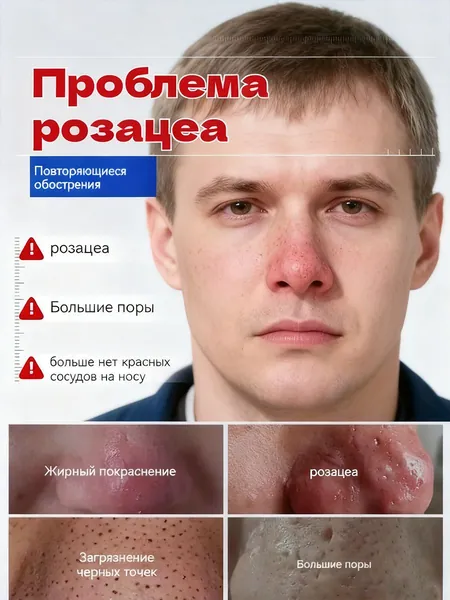 винная мазь для носа отрозацея и купероза,крем для личения розацеа кожи лица,мазь сосуды носа,Гельтек Гель Демотен Форте от прыщ, крем регенерирующий, 20г