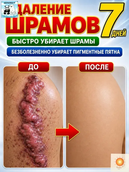 Этот крем от шрамов можно наносить на любую часть тела, он помогает избавиться от растяжек, ожогов и пигментных пятен. Его также можно использовать для лечения шрамов от постакне. 100 мл