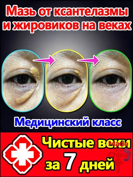 Средство от ксантелазмы без операции: уход за кожей век