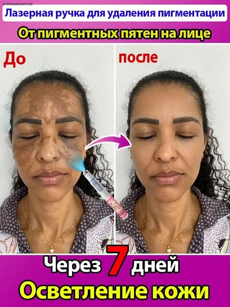 Лазер от веснушек, используемый для удаления веснушек, меланодермии, пигментных пятен, солнечных ожогов, красоты лица, безболезненный и без побочных эффектов