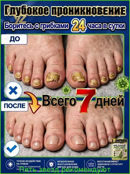 Пластыри для лечения онихомикоза, предназначенные для лечения онихомикоза рук и ног, направлены на борьбу с утолщенными, слоистыми и обесцвеченными ногтями, 21 пластырь в упаковке.